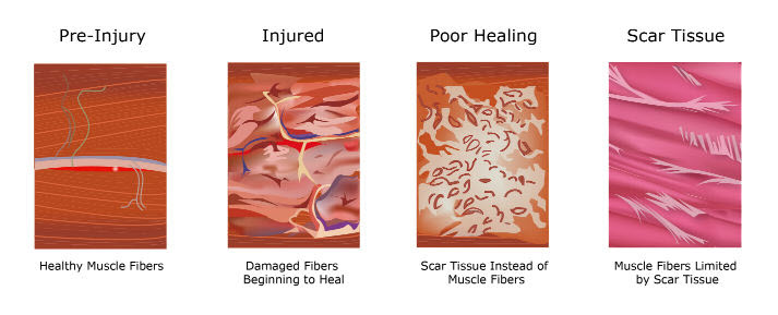 Soft Tissue fibrosis stages