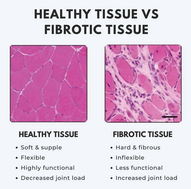 Soft Tissue Fibrosis & Adhesion - What does the research say?