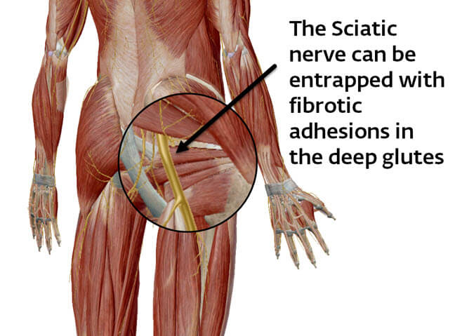 Piriformis Syndrome (entrapment of the sciatic nerve causing sciatica)