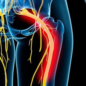 sciatica1