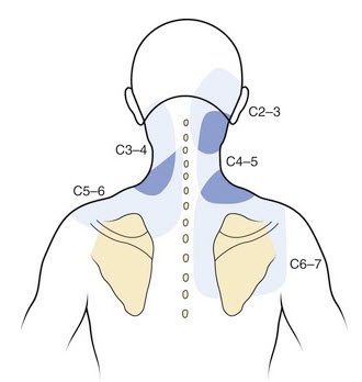 Pain Near the Shoulder Blade - It's probably not just a trigger point!