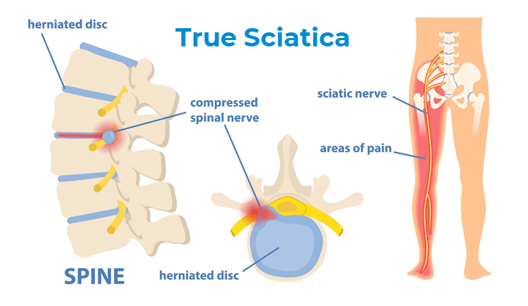 Sciatic Nerve Entrapment: A real pain in the butt